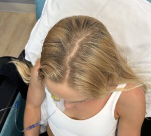Close-up of Tanner’s scalp showing healthy hair retention during chemotherapy.