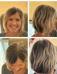 Dana’s hair after chemotherapy showing strong regrowth and minimal hair loss from cold capping